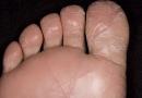 Причины и лечение шелушения кожи на ногах Раздражение на ногах чешется и шелушится