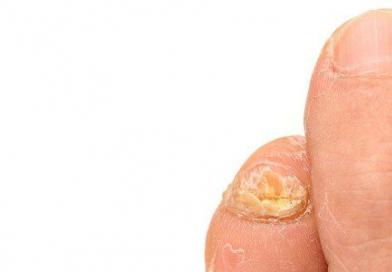 Как вылечить грибок ногтей народными средствами