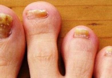 Народное лечение грибка ногтей на ногах
